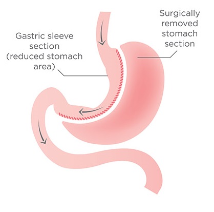 gastric sleeve